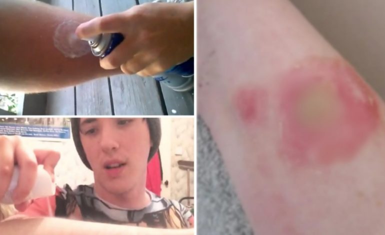 PRINDËR KUJDES/ Adoleshentët po dëmtojnë veten me sfidën e rrezikshme të deodorantëve në TikTok
