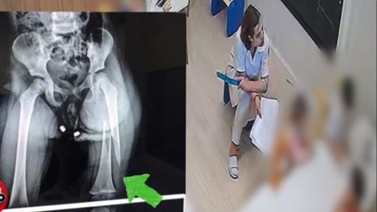 PUBLIKOHEN PAMJET/ Momenti SHOKUES në kopshtin pa licencë, si iu thye këmba 3-vjeçares nga edukatorja