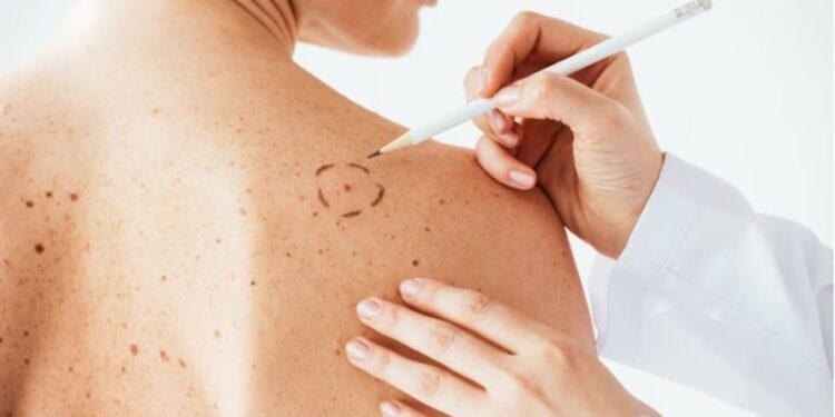 SHPRESA PËR KANCERIN E LËKURËS/ Testohet vaksina për trajtimin e melanomës