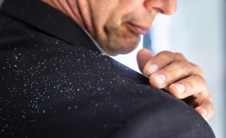 ZBOKTH APO PSORIAZË? Përse skalpi i kokës është gjithmonë i irrituar
