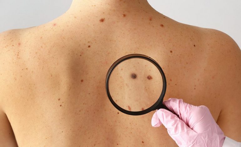 MELANOMA/ 10 mite dhe të vërteta për kancerin e lëkurës
