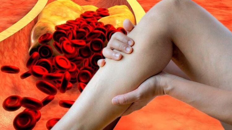 HIDHINI NJË SY/ Shenjat që jep trupi kur keni kolesterol të lartë në gjak