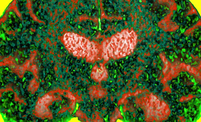 STUDIMI I RI: Njerëzit që kanë këto dy kopje të gjenit do të preken nga Alzheimeri