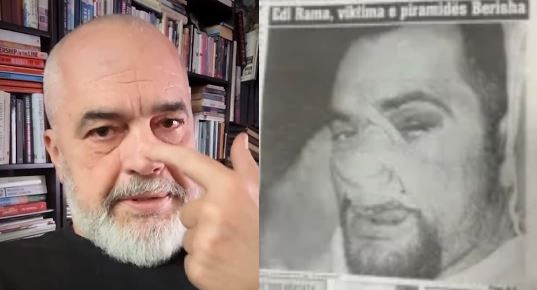 “SY M’SY”/ Rama i përgjigjet komentuesit: Partia që të ka mbushur mendjen se jam drogaxhi më ka thyer hundën dhe kafkën me leva