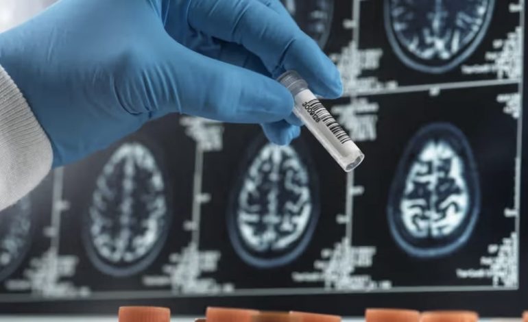 STUDIMI I RI/ Si një analizë gjaku mund të zbulojë sëmundjen e Alzheimerit