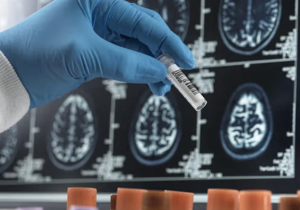 STUDIMI I RI/ Si një analizë gjaku mund të zbulojë sëmundjen e Alzheimerit