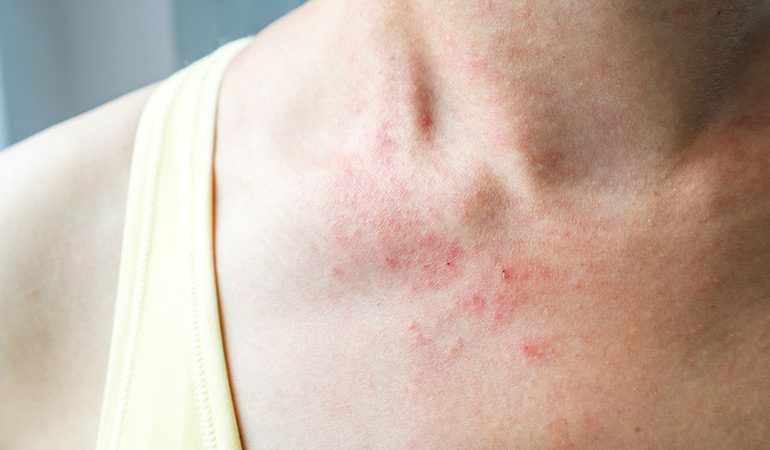 KINI KUJDES ME KONDICIONERIN NË KËTO DITË PËRVËLUESE/ Do të SHOKOHENI kur të zbuloni se çfarë i shkakton lëkurës