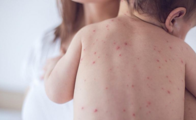 ALARM/ “Shpërthen” fruthi në kryeqytet, 15 të mitur të infektuar benda një kopshti
