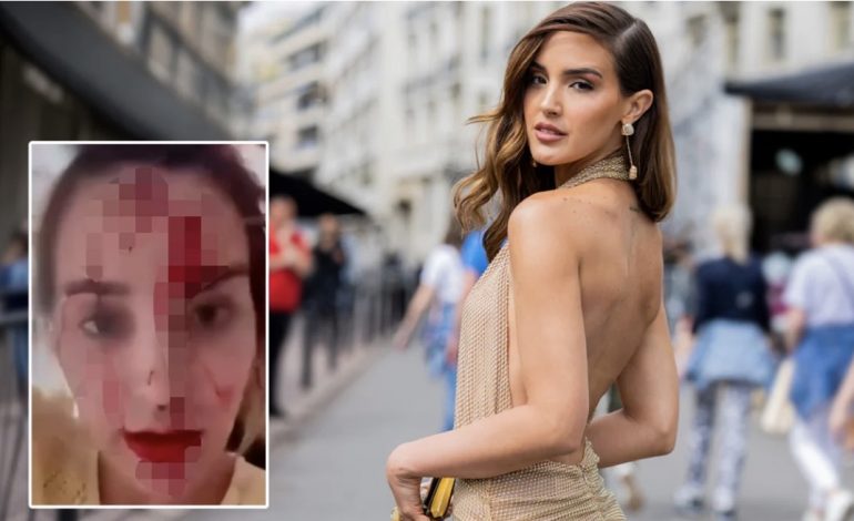 SKANDAL NË KANË/ Miss Venezuela publikon videon tronditëse me fytyrën e mbuluar në gjak, akuzon stilistin e njohur për dhunë